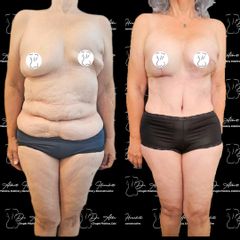 Abdominoplastia - Dr. Alberto Hiracheta