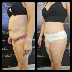 Abdominoplastia - Dr. Alberto Hiracheta