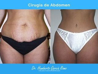 Antes y después de Abdominoplastia