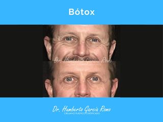 Antes y después de toxina botulínica