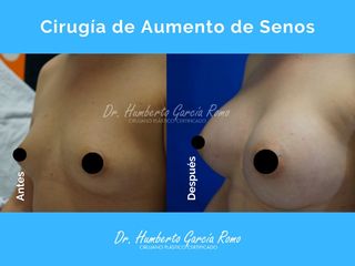 Antes y después de Aumento de Busto