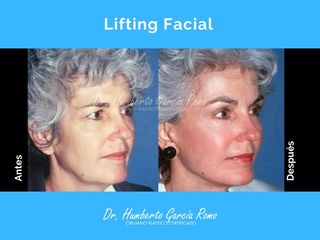 Antes y después de Lifting Facial