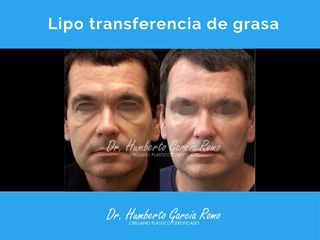 Antes y después de Lipo transferencia Facial