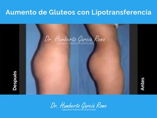 Antes y después de Aumento de Glúteos con Lipo Transferencia
