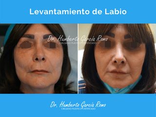 Aumento de labios - Dr. Jorge Humberto García Romo