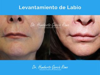 Aumento de labios - Dr. Jorge Humberto García Romo