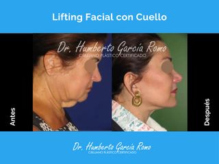Lifting Facial con Cuello - Dr. Jorge Humberto García Romo