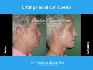 Lifting Facial con Cuello - Dr. Jorge Humberto García Romo