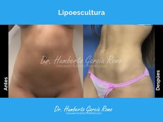 Lipoescultura - Dr. Jorge Humberto García Romo