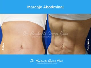 Marcaje Abdominal - Dr. Jorge Humberto García Romo