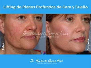 Lifting de Cara y Cuello - Dr. Jorge Humberto García Romo