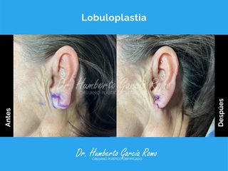 Lobuloplastia - Dr. Jorge Humberto García Romo