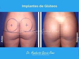 Gluteoplastia - Dr. Jorge Humberto García Romo