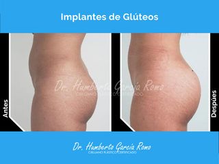 Gluteoplastia - Dr. Jorge Humberto García Romo