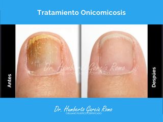 Onicomicosis - Dr. Jorge Humberto García Romo