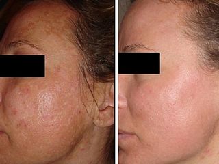 Antes y después de rejuvenecimiento facial