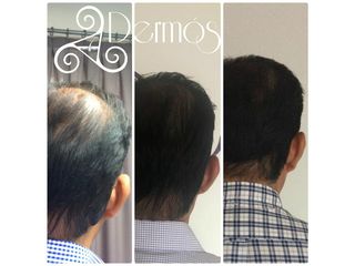 Antes y después de AAPE: Tratamiento de celulas madre para crecimiento de cabello.