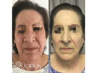 Antes y después de Tratamiento: AAPE celulas madre en rostro 