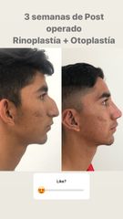 Antes y después de Rinoplastía Estética + Otoplastía