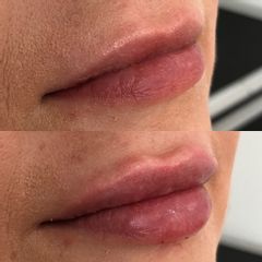 Antes y después de Aumento de Labios con Ácido Hialurónico 