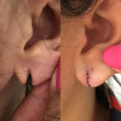 Lobuloplastia: Reparación de desgarro del lóbulo de la oreja por aretes pesados