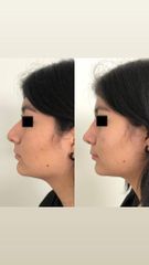 Rinoplastia funcional y estética