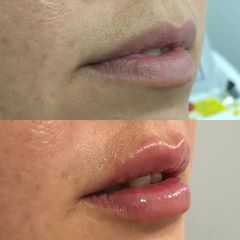 Aumento de labios