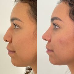 Antes y después de Rinoplastia