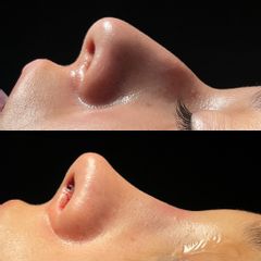 Antes y después de Rinoplastia