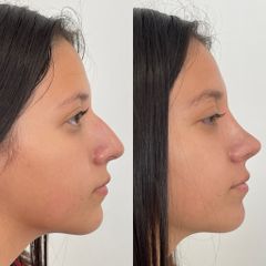 Antes y después de Rinoplastia