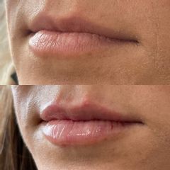 Antes y después de Aumento de labios con ácido hialurónico 