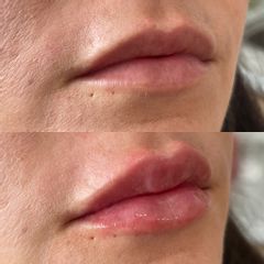 Antes y después de Aumento de labios con ácido hialurónico
