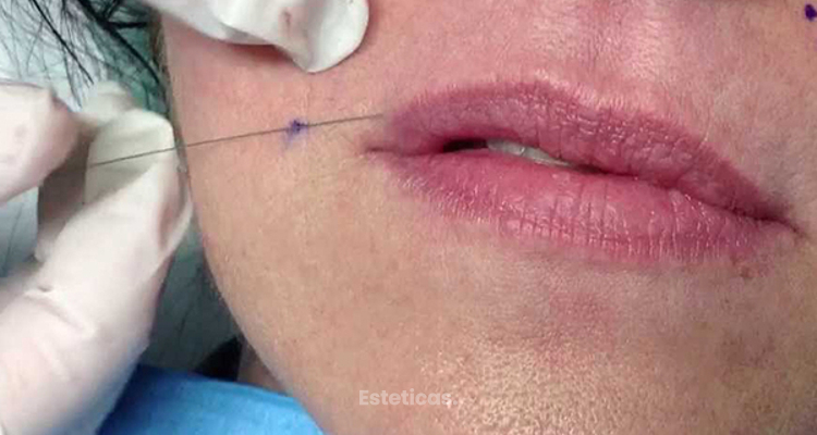 Needle Shaping: un método innovador para el rostro sin inyecciones y sin cirugía