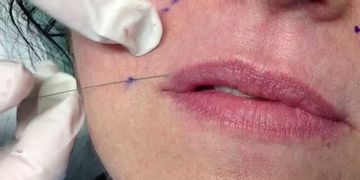 Needle Shaping: un método innovador para el rostro sin inyecciones y sin cirugía