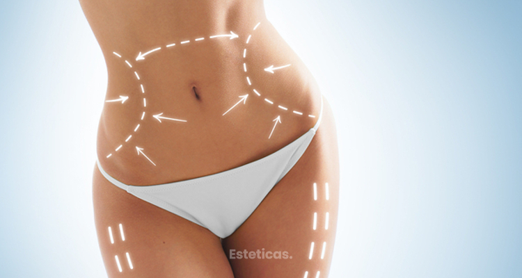 Celulitis en varias zonas del cuerpo