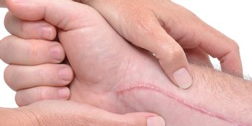 Algunas cuestiones sobre la cirugía correctora de cicatrices
