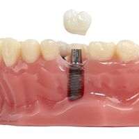 La historia de los implantes dentales por Dental Advance