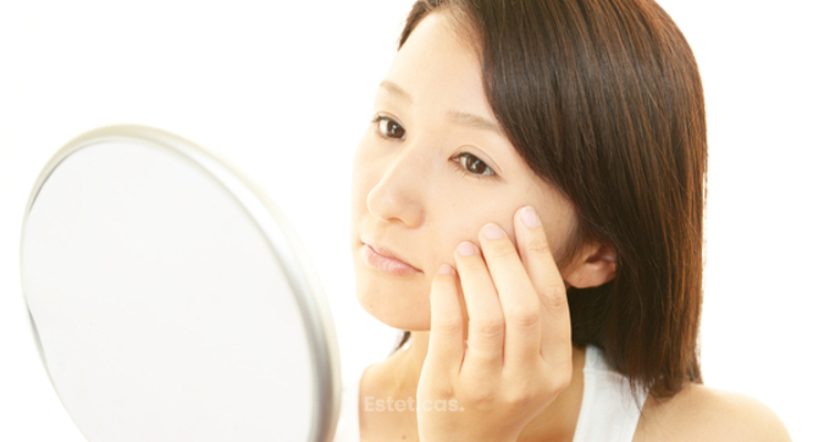 Alteraciones estéticas de la piel facial: cuperosis