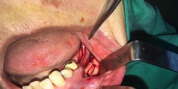 Regeneración osea y Plasma Rico en Plaquetas