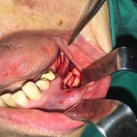 Regeneración osea y Plasma Rico en Plaquetas