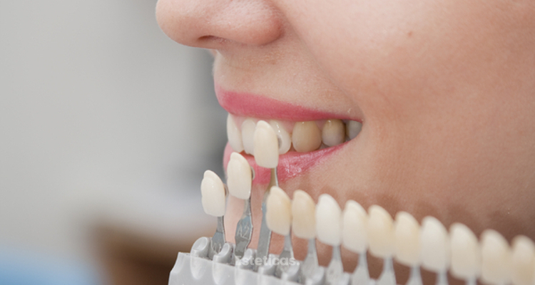 Prótesis dentales para mejorar la sonrisa