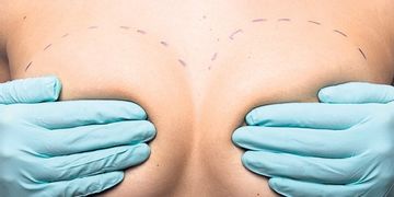 Rinoplastia y aumento de mamas: preguntas frecuentes