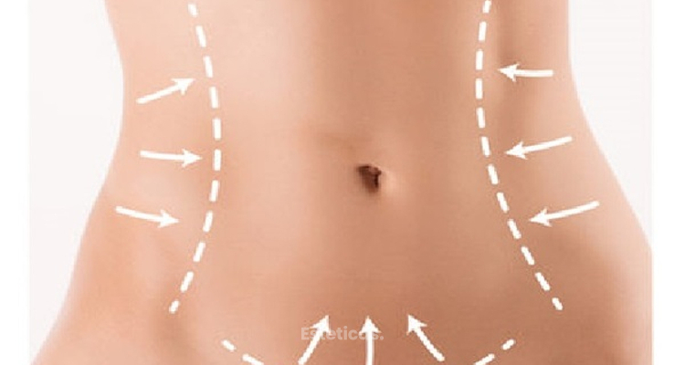 Qué tener en cuenta antes de una cirugía de abdomen