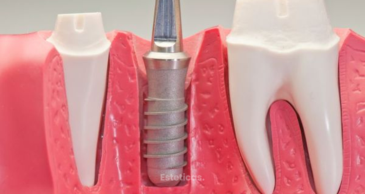 Implantes dentales de zirconio: La mejor opción
