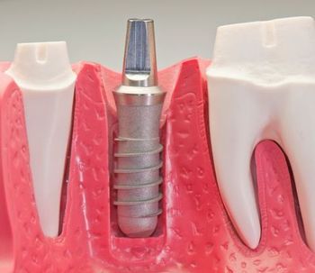 Implantes dentales de zirconio: La mejor opción
