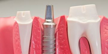 Implantes dentales de zirconio: La mejor opción