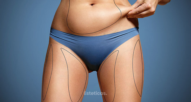 Todo lo que tenés que saber sobre la abdominoplastia