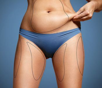 Todo lo que tenés que saber sobre la abdominoplastia