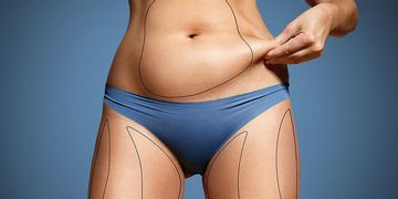 Todo lo que tenés que saber sobre la abdominoplastia