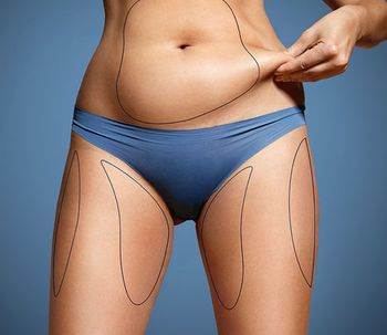 Tipos de abdominoplastia: ¿cuál se adapta mejor a cada caso?
